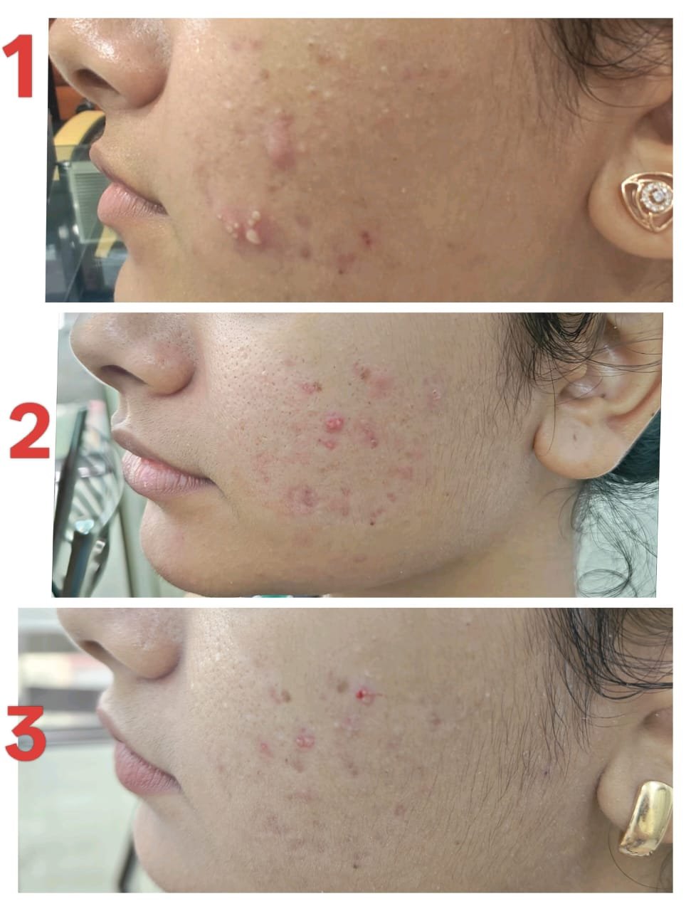 Acne treatment progress
