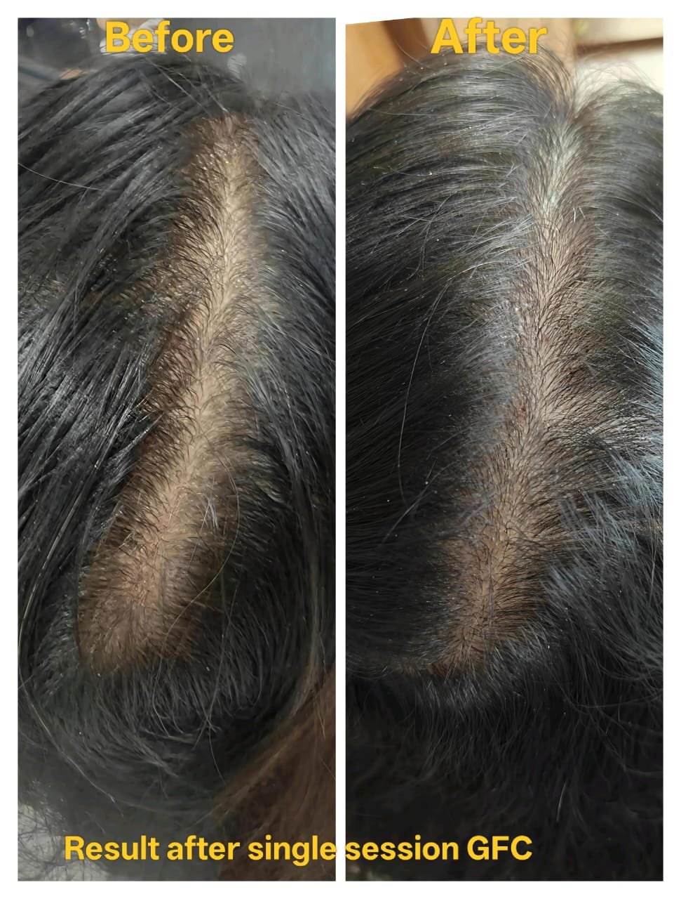 Double chin reduction before and after