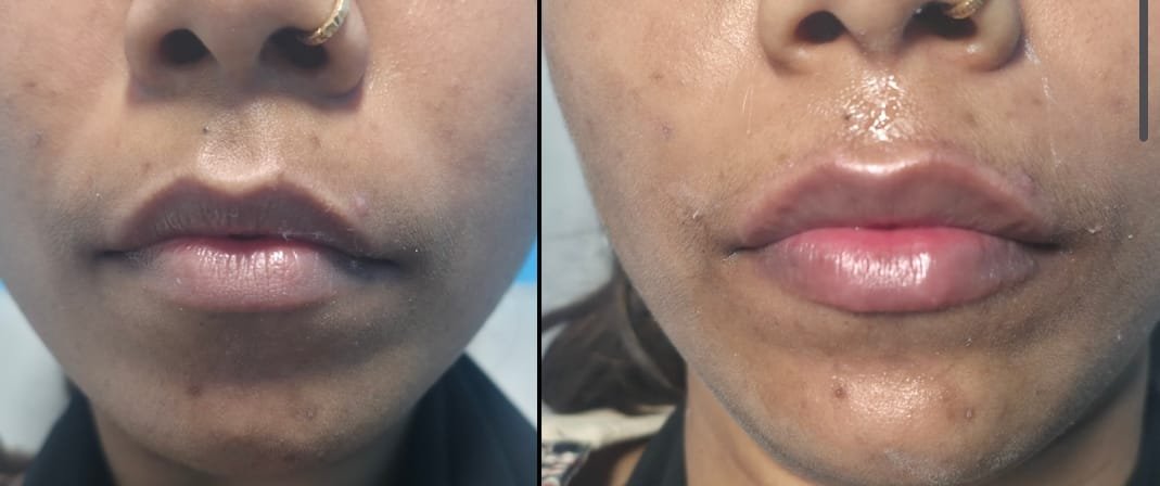 Hair growth result after 3 months