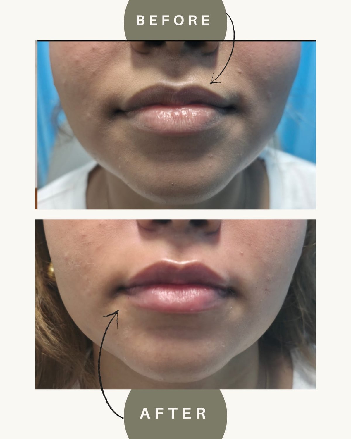 Lip filler result before and after