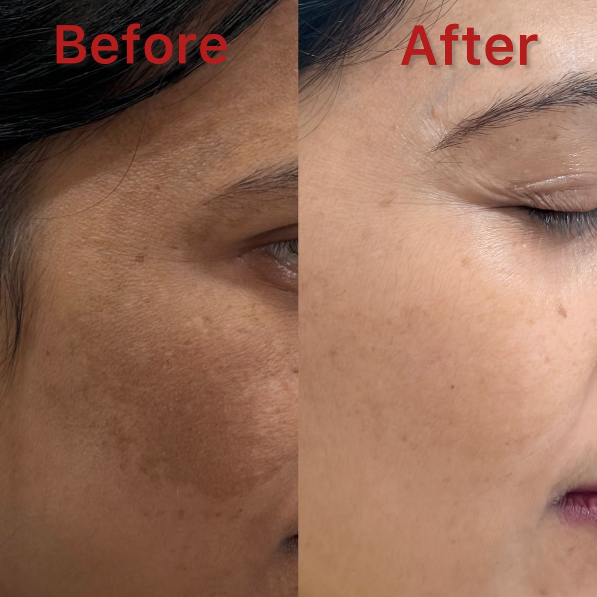 Skin brightening before and after