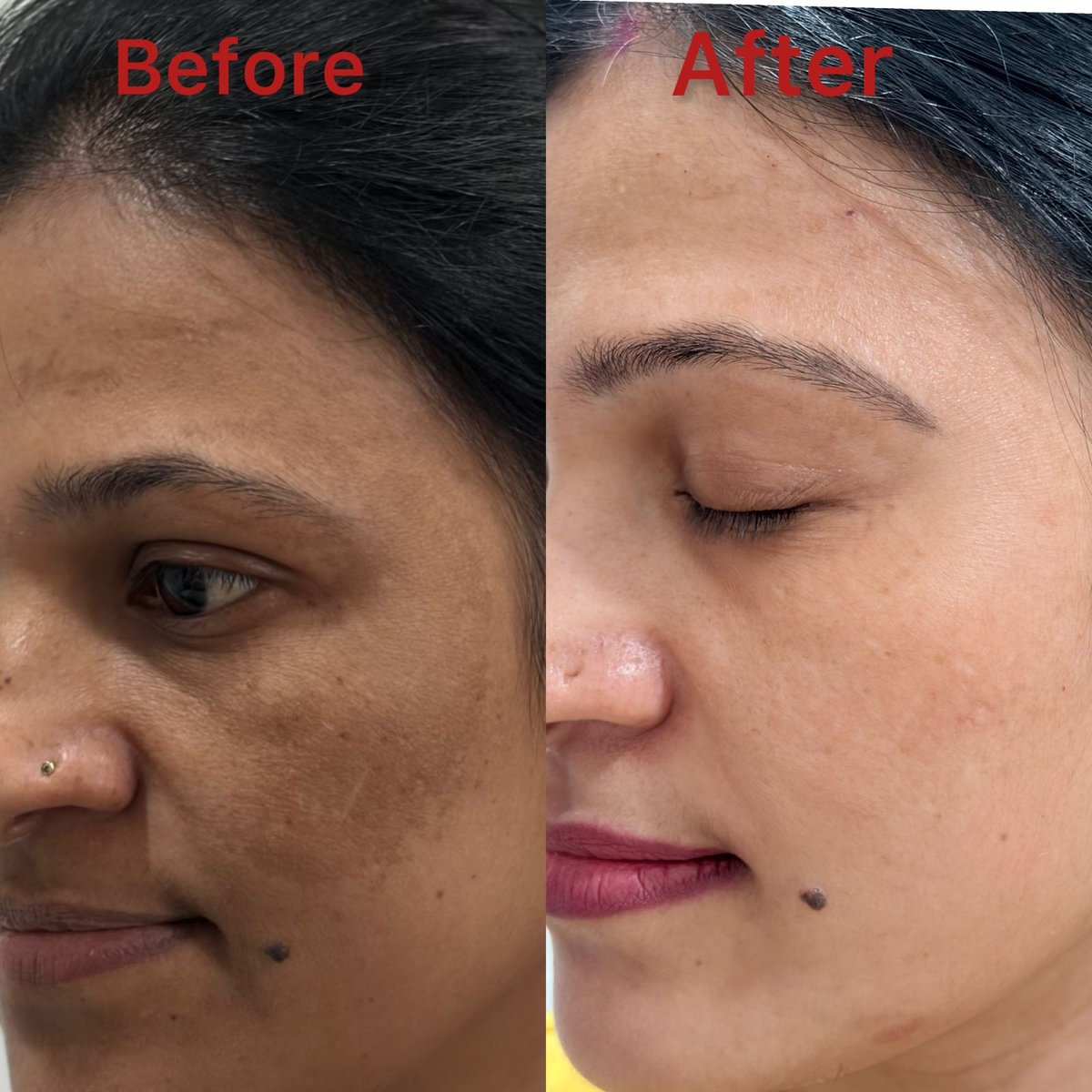 Complexion improvement before and after